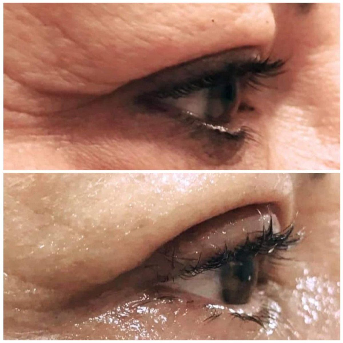 Résultats de blépharoplastie avant et après à Italian Eye Hospital, correction des paupières