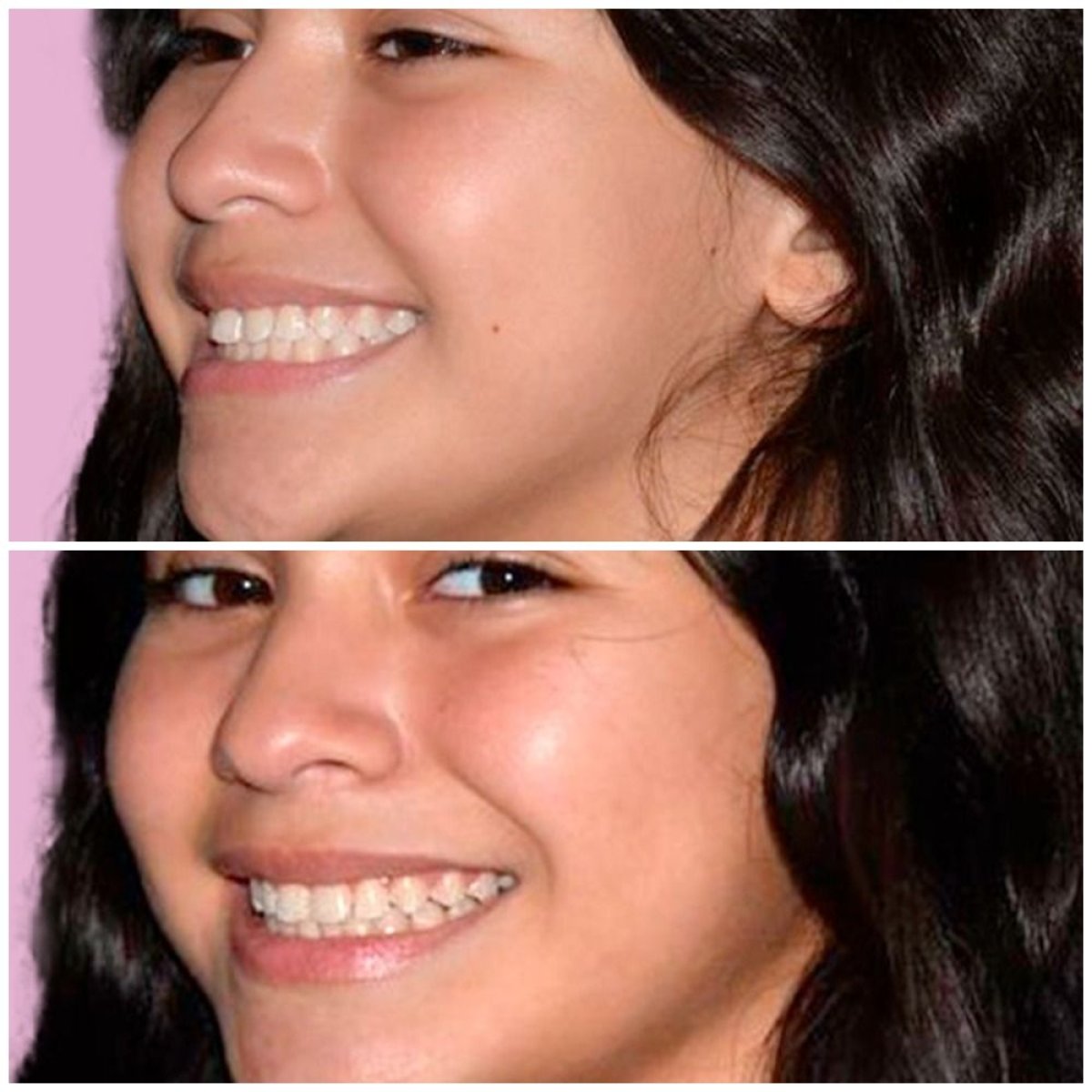 نتائج قبل وبعد تقويم Invisalign في YeahSmile – تحسين انتظام الأسنان والابتسامة