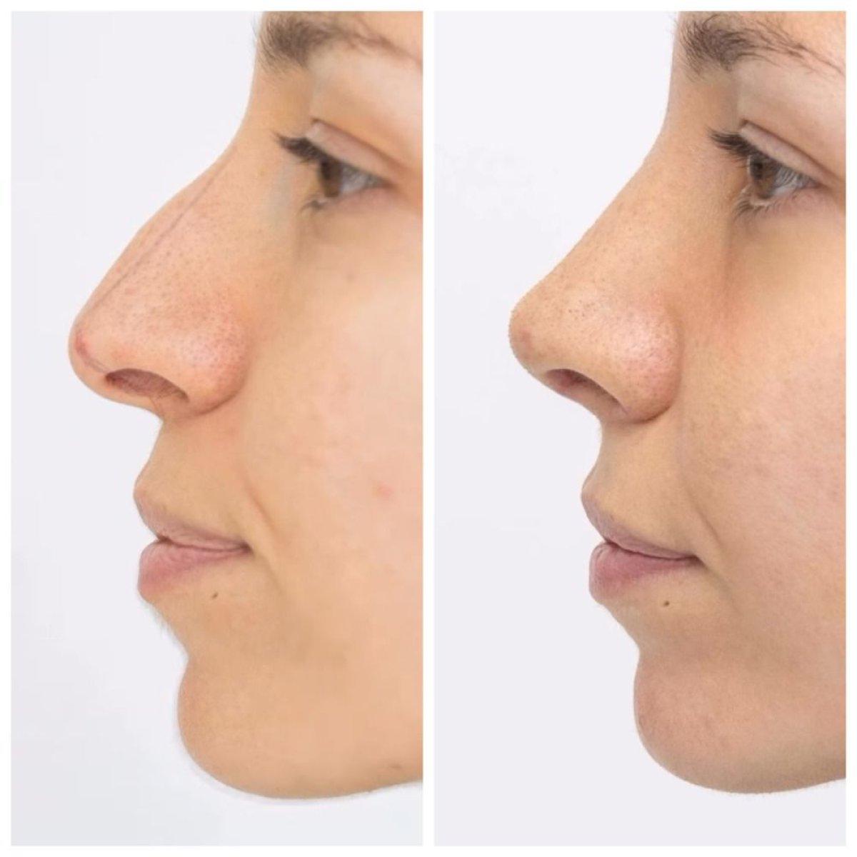 Before and after rhinoplasty results at EDEN AESTHETICS, nose reshaping with natural look