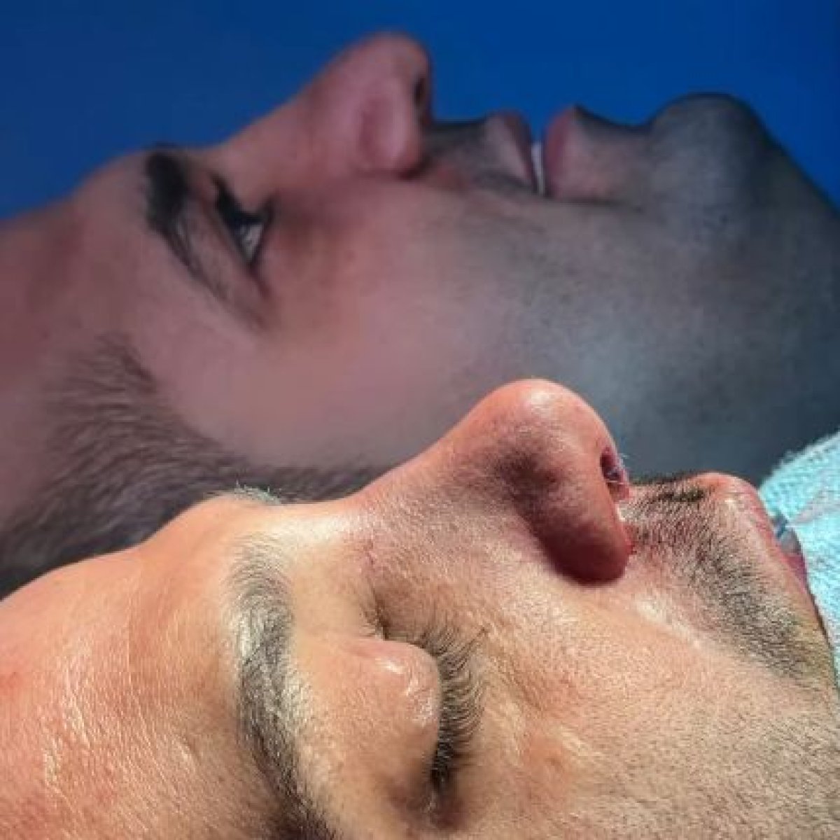 نتائج تجميل الأنف قبل وبعد لمريض ذكر في EDEN AESTHETICS، إعادة تشكيل الأنف