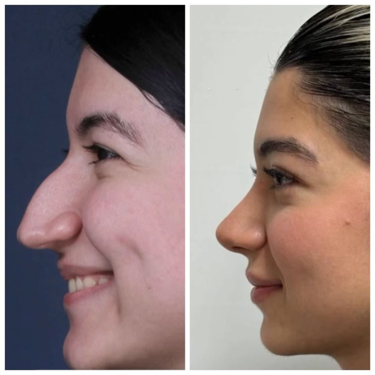 Before and after rhinoplasty results at EDEN AESTHETICS, nose reshaping with natural look