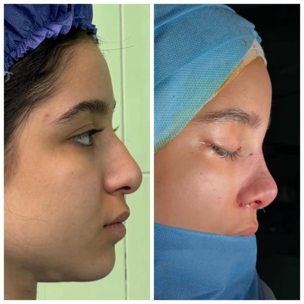 نتائج عملية تجميل الأنف قبل وبعد في EDEN AESTHETICS، إعادة تشكيل الأنف بشكل طبيعي