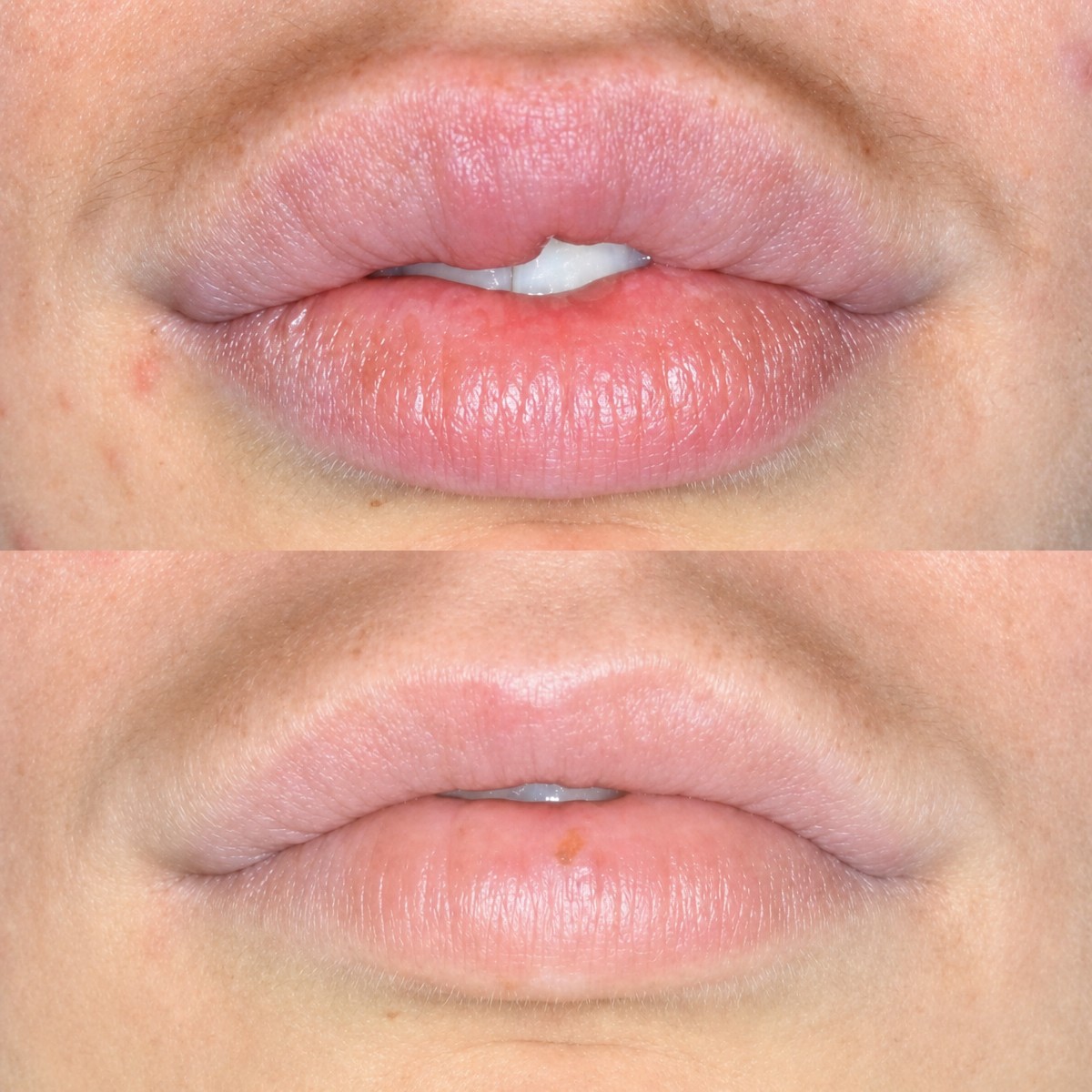 Before and after lip reduction results at Memorial Şişli Hospital, improved lip contour