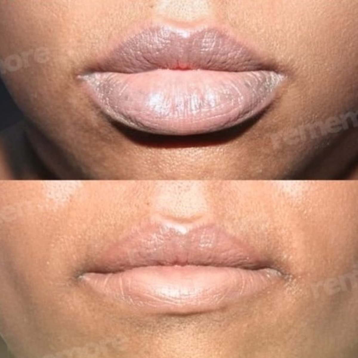 Resultados de reducción de labios antes y después en Memorial Şişli Hospital, labios más delgados