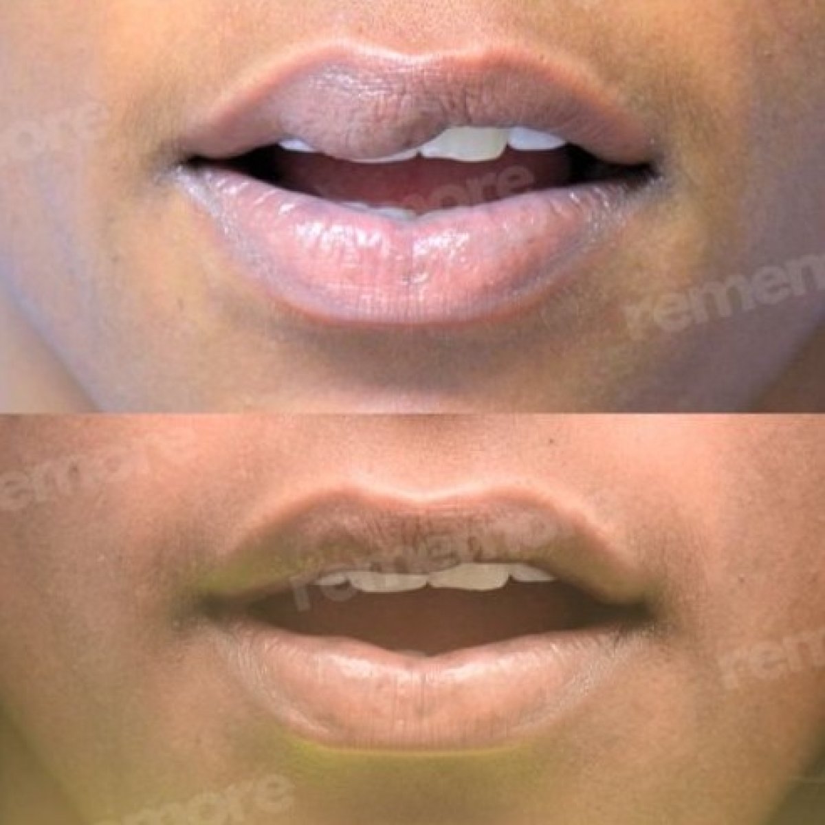 Before and after lip reduction results at Memorial Şişli Hospital, visible slimmer lips