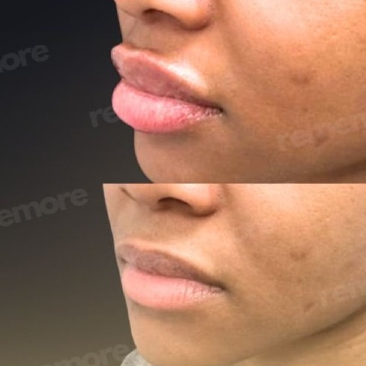 Before and after lip reduction results at Memorial Şişli Hospital, improved lip contour