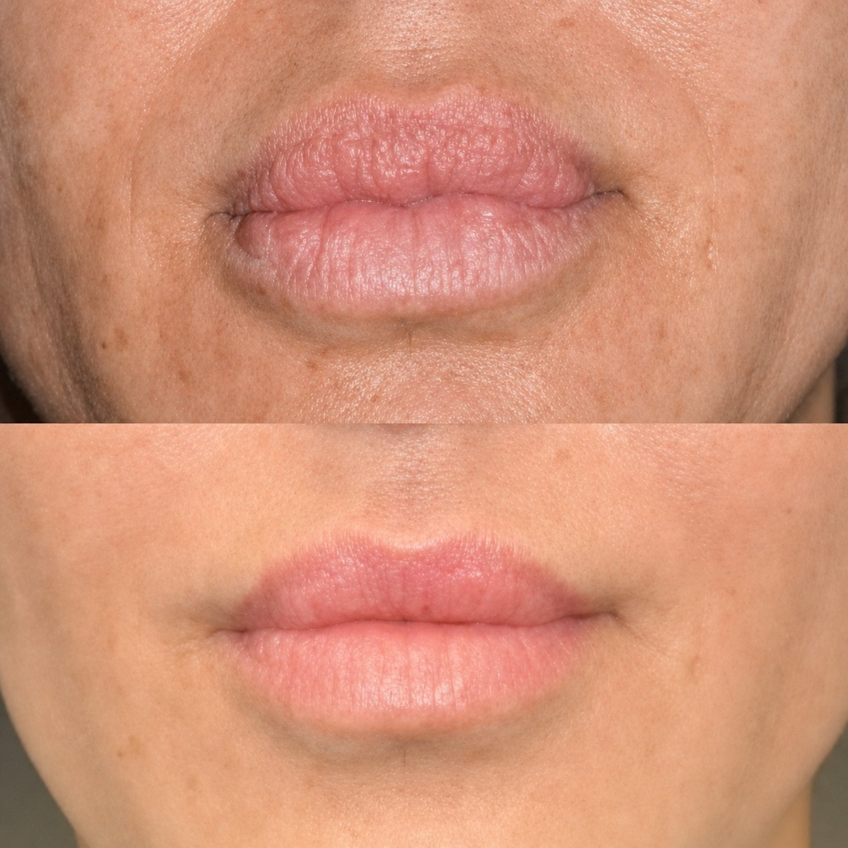 Resultados antes y después de reducción de labios en Memorial Şişli Hospital, contorno mejorado