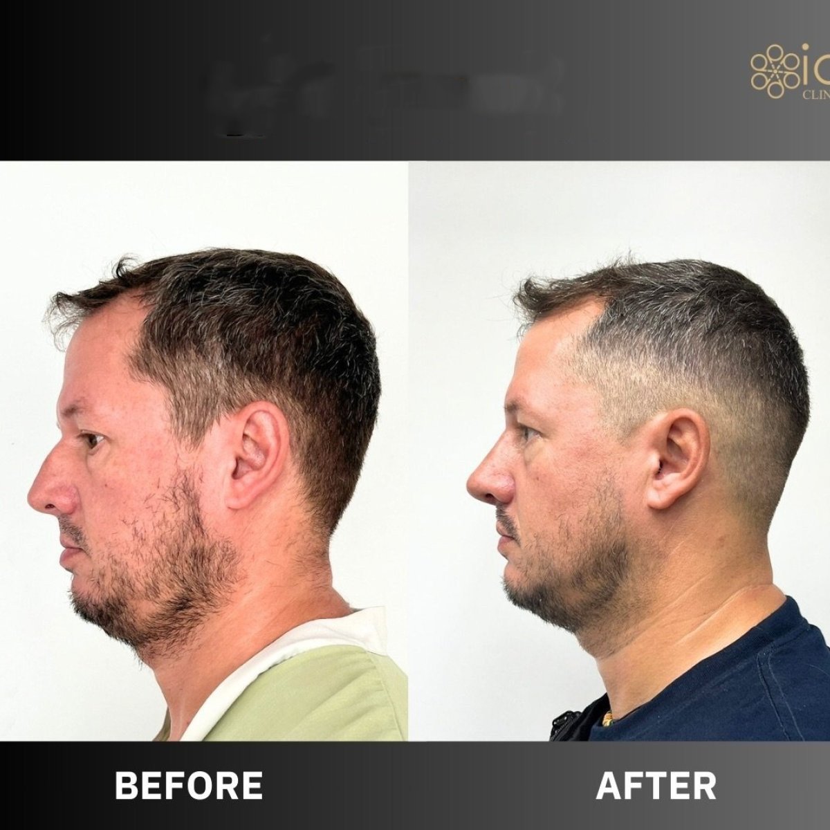 Before and after open rhinoplasty result at ID Clinic Bangkok, improved nose profile in male