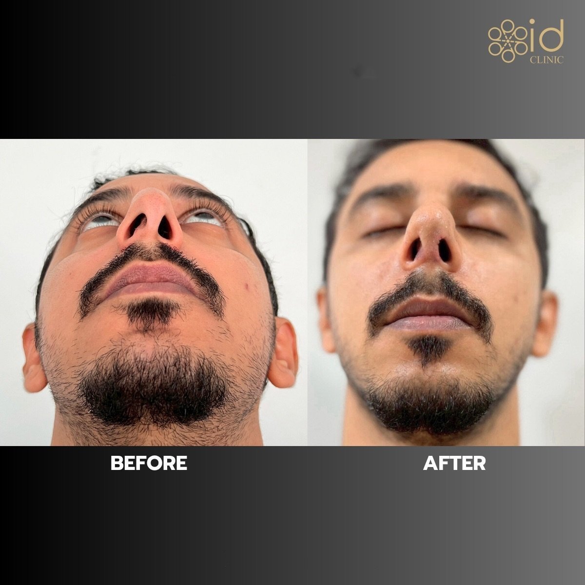 Before and after open rhinoplasty results at ID Clinic Bangkok, improved nasal shape and symmetry