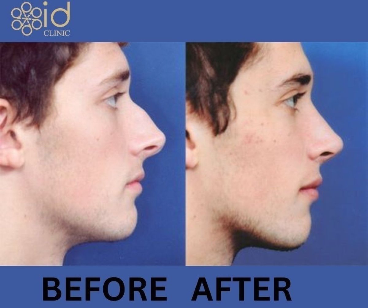 Before and after open rhinoplasty results at ID Clinic Bangkok, improved nose profile