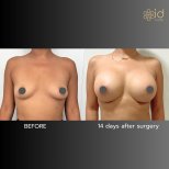 Fotos vor und nach Brustvergrößerung durch Dr. Dr Phatcharasak Kraisornphongsakul Md