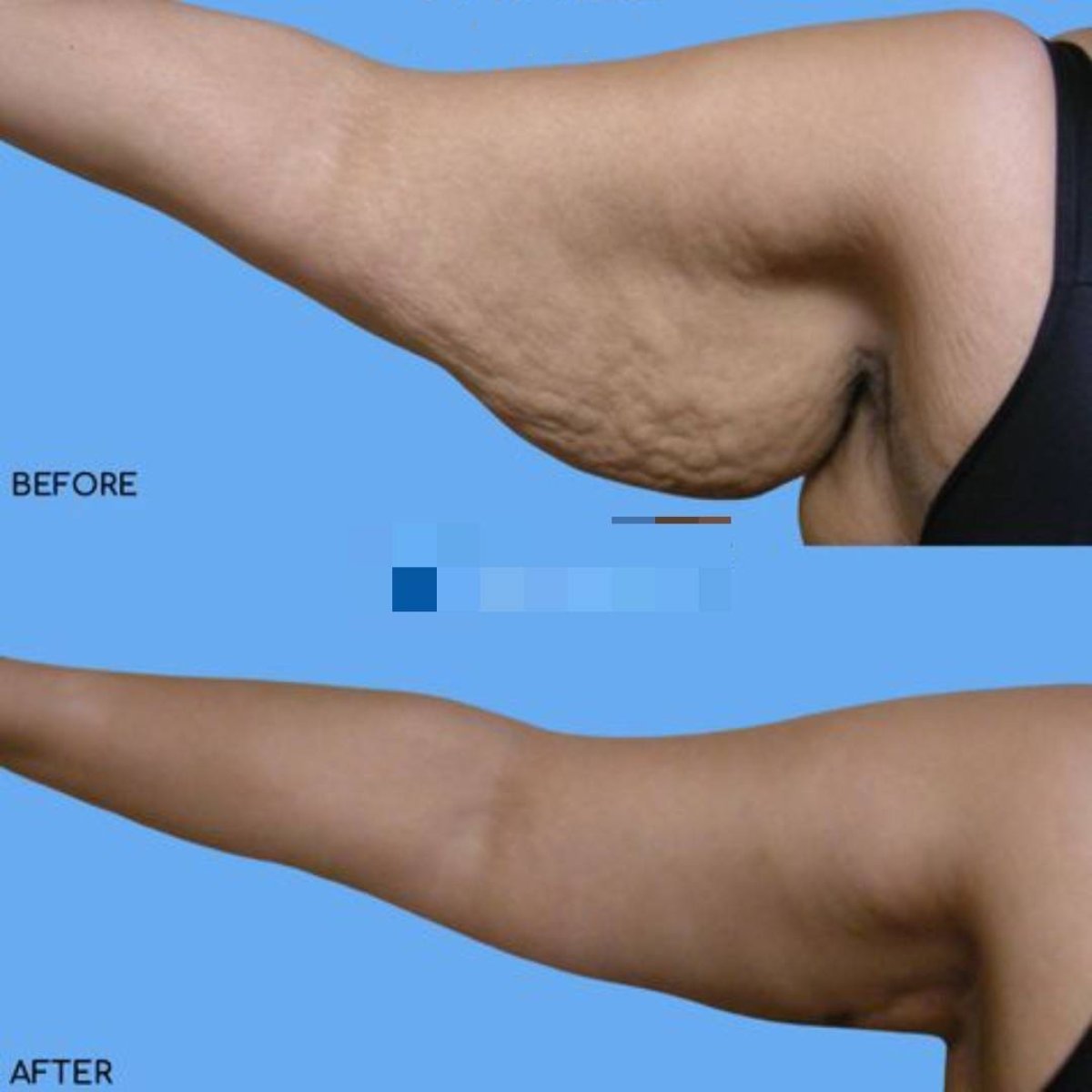 Before and after arm lift (brachioplasty) result at ID Clinic Bangkok, improved arm contour