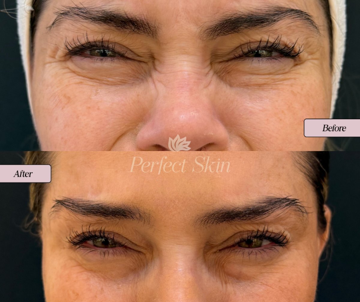 نتيجة بوتوكس الجبهة قبل وبعد في عيادة Perfect Skin، بشرة أكثر نعومة