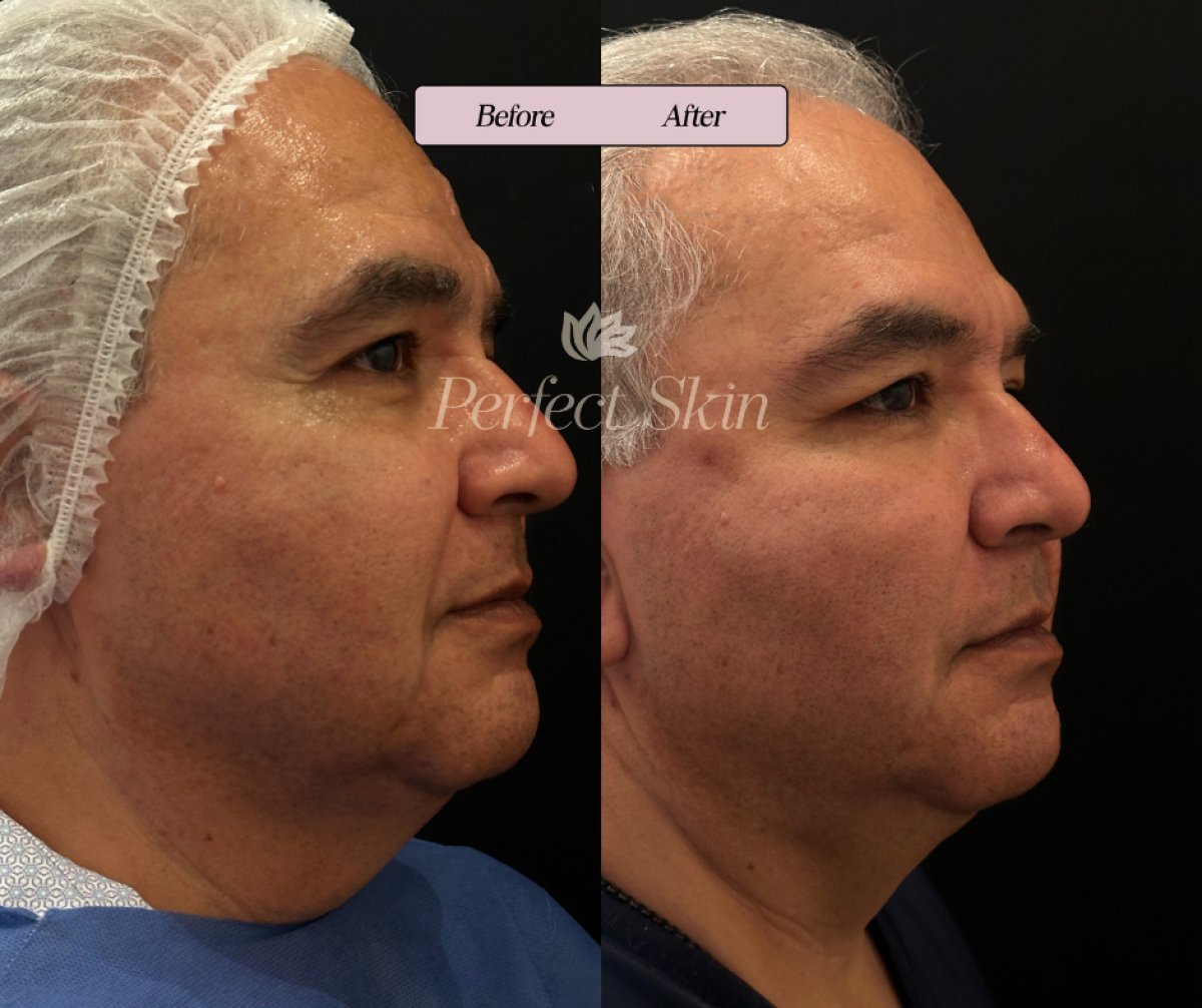 نتيجة شد الوجه بالخيوط قبل وبعد في عيادة Perfect Skin – رفع واضح لملامح الوجه