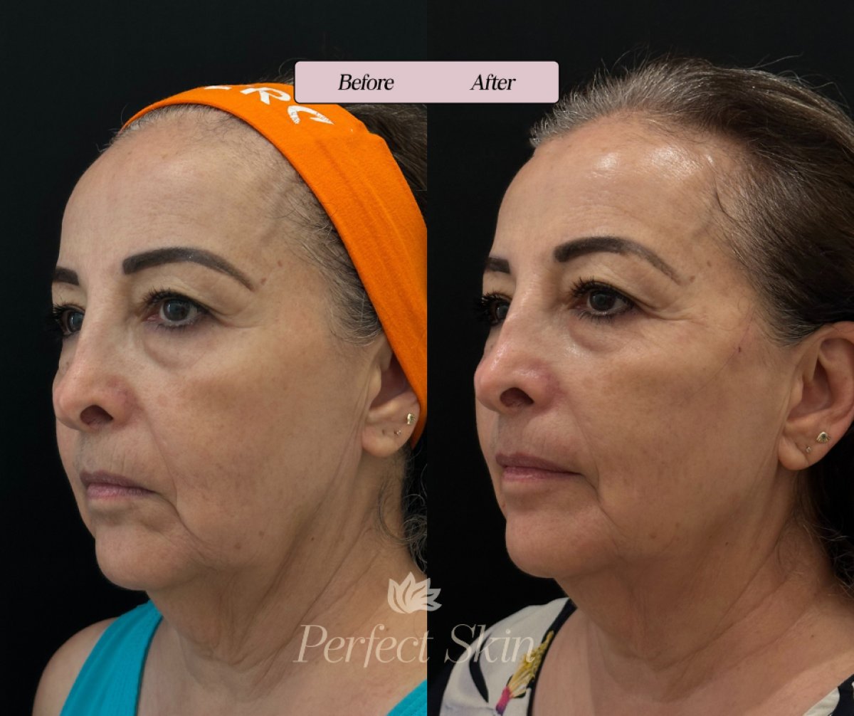 نتائج شد الوجه بالخيوط في عيادة Perfect Skin – شد واضح لبشرة الوجه