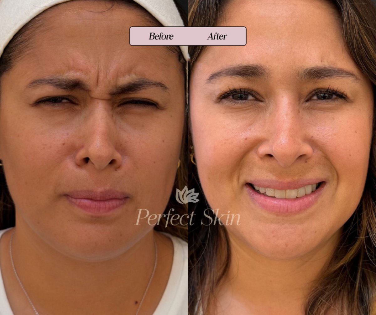 До и после инъекций ботокса в клинике Perfect Skin, результат уменьшения морщин лба
