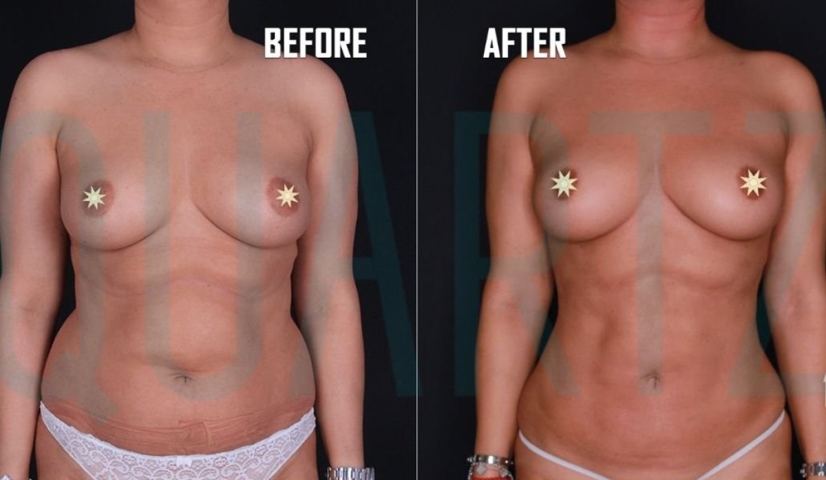 Resultados de liposucción antes y después en Quartz Hospital – mejora visible del contorno corporal