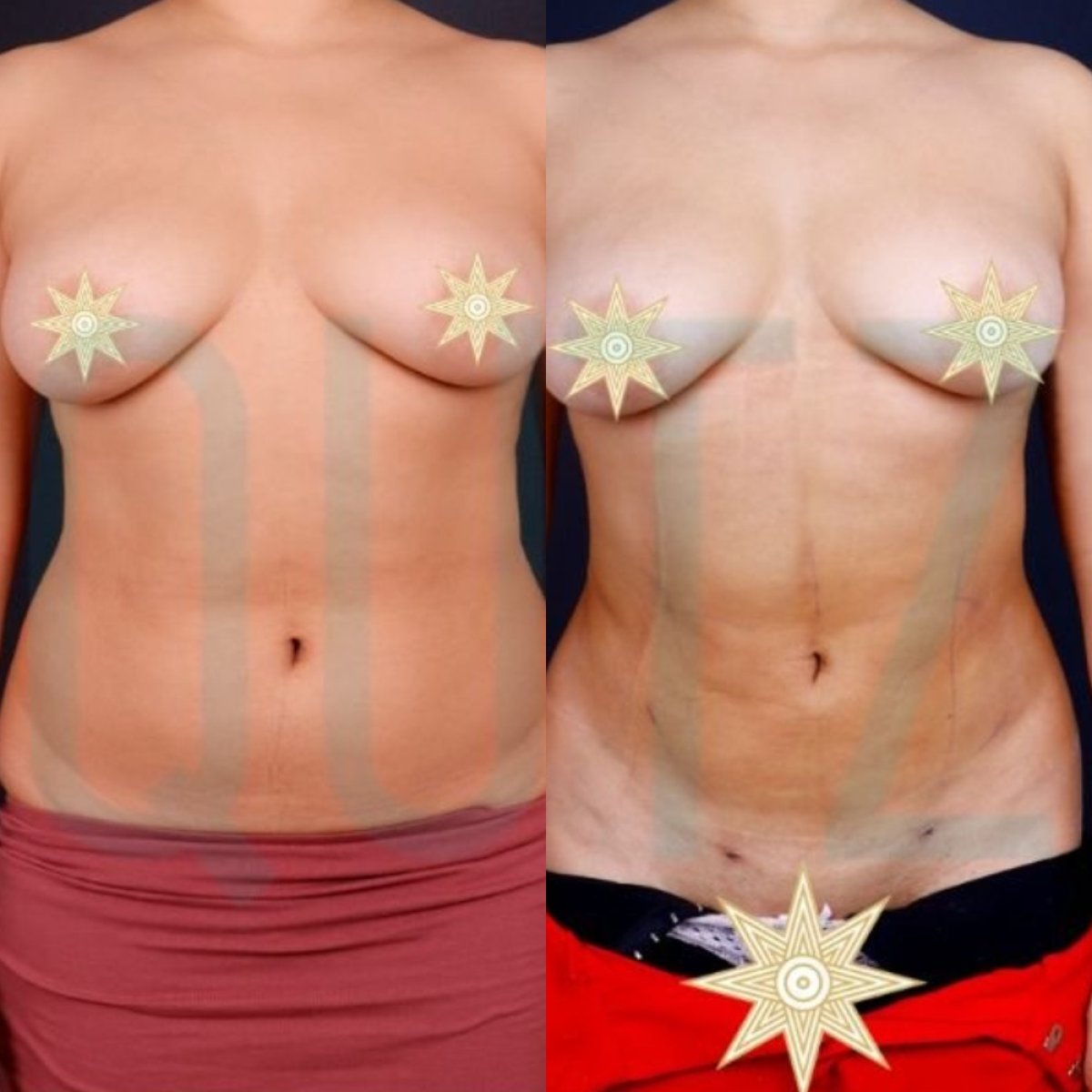 Before and after liposuction results at Quartz Hospital, visible waist and abdomen contouring