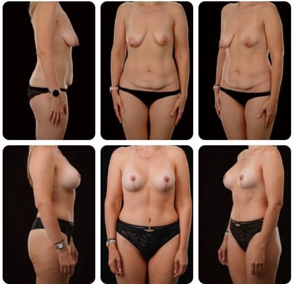Résultats avant/après réduction mammaire chez Yurchenko Plastic Surgery Team, contour amélioré