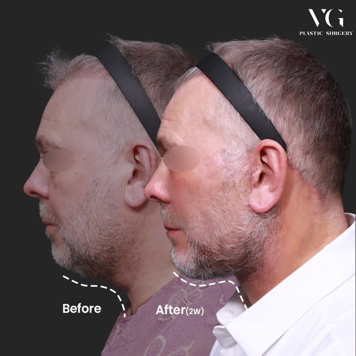Facelift before and after results at VG Plastic Surgery, improved jawline and neck contour