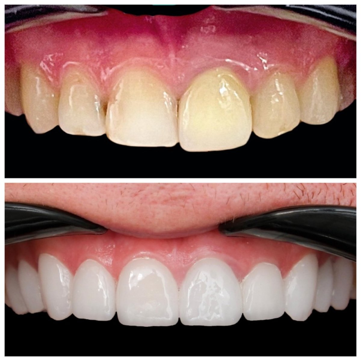 Before and after Hollywood Smile results at Soraca Med – dental veneers for whiter teeth