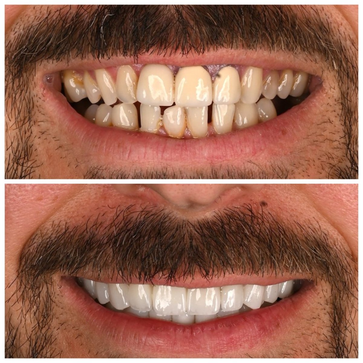 Hollywood Smile before and after results at Soraca Med – whiter, even teeth transformation