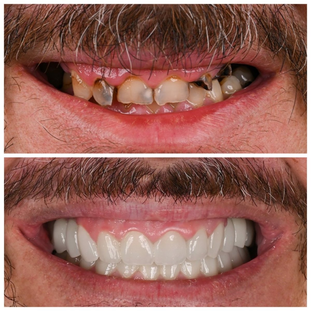 نتائج قبل وبعد ابتسامة هوليود في Soraca Med – تحول كامل للابتسامة
