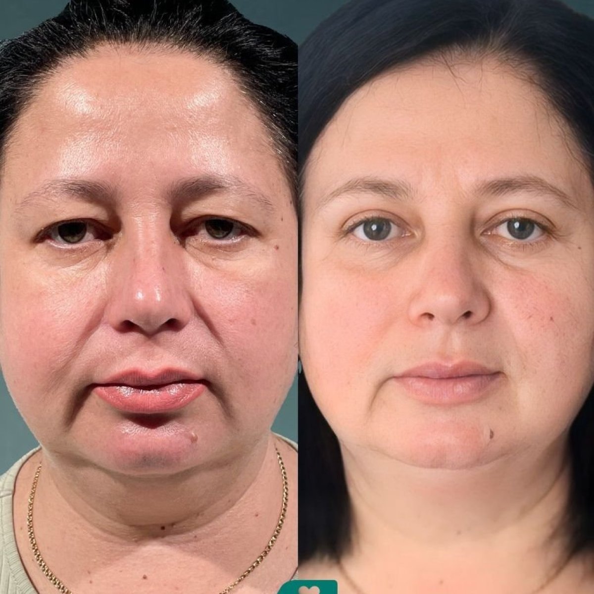 Before and after blepharoplasty results at Soraca Med – eyelid correction for youthful look