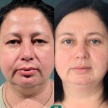 Before and after Blepharoplasty (Eyelid correction) photos by Dr. 
