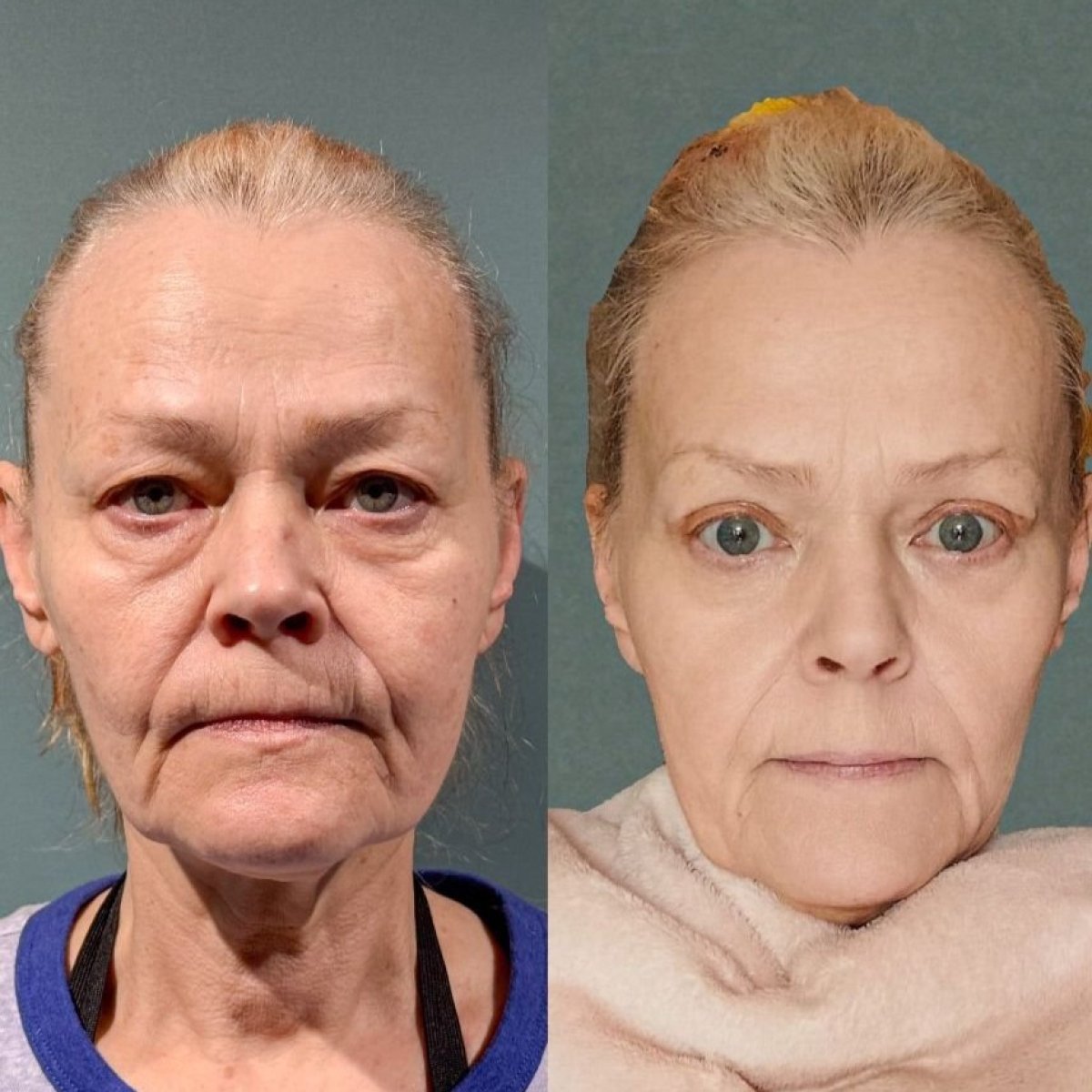 Before and after blepharoplasty results at Soraca Med, eyelid correction for youthful look