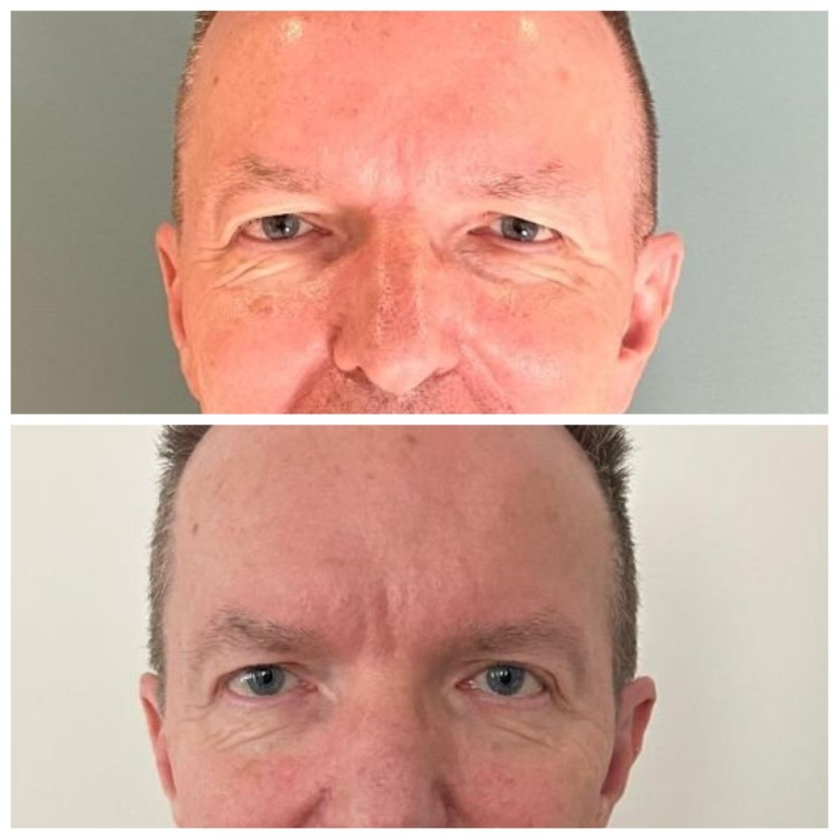 Before and after blepharoplasty results at Soraca Med, eyelid correction for rejuvenated look