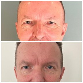 Upper Blepharoplasty with Same-Day Discharge — 4 Hotel & VIP Transfers - photo 4