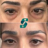 Before and after Blepharoplasty (Eyelid correction) photos by Dr. 
