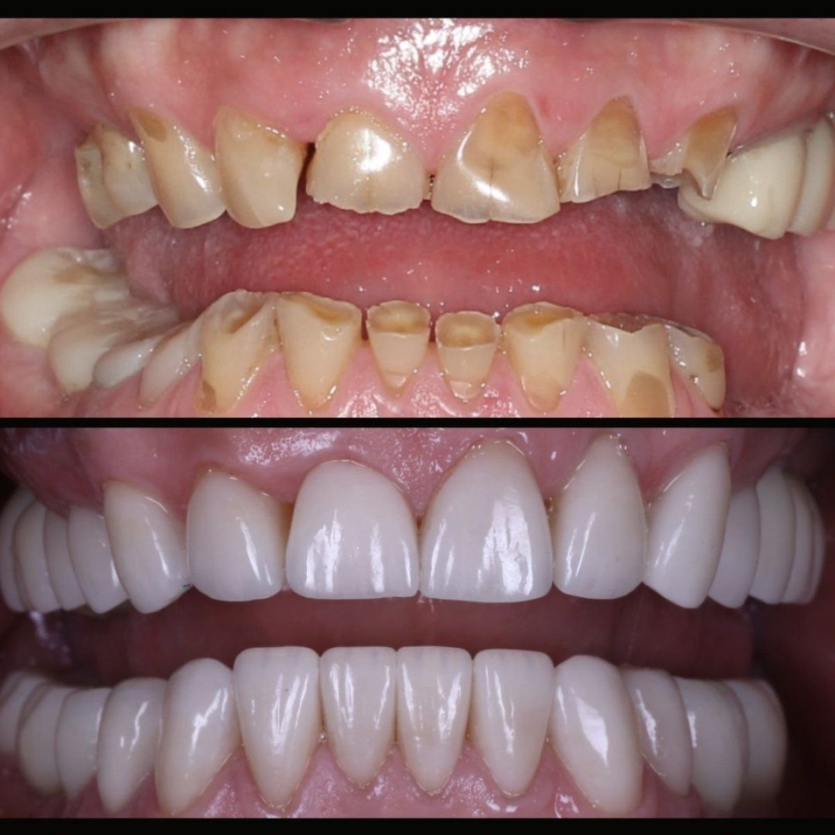 Antes y después de coronas de zirconia en Smile Centrum, transformación visible de la sonrisa