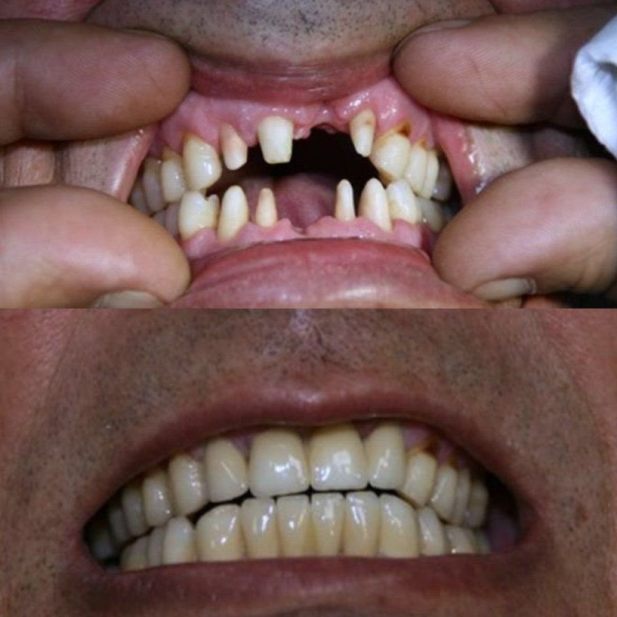 Resultados antes y después de coronas de zirconio en Smile Centrum, sonrisa restaurada