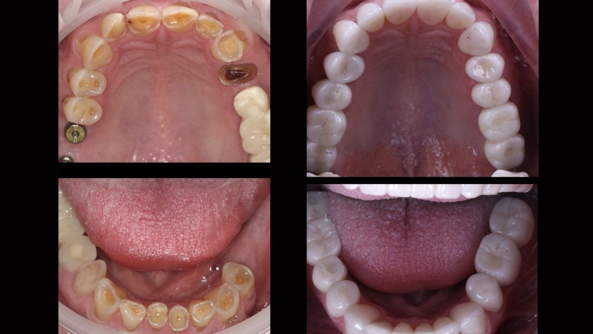 Before and after zirconia crown installation results at Smile Centrum, restored healthy teeth
