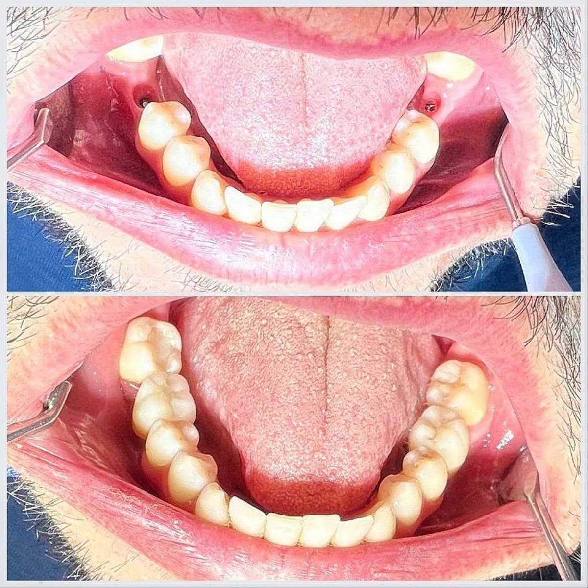 Результаты до и после имплантации зубов в Smile Centrum, восстановлены нижние моляры