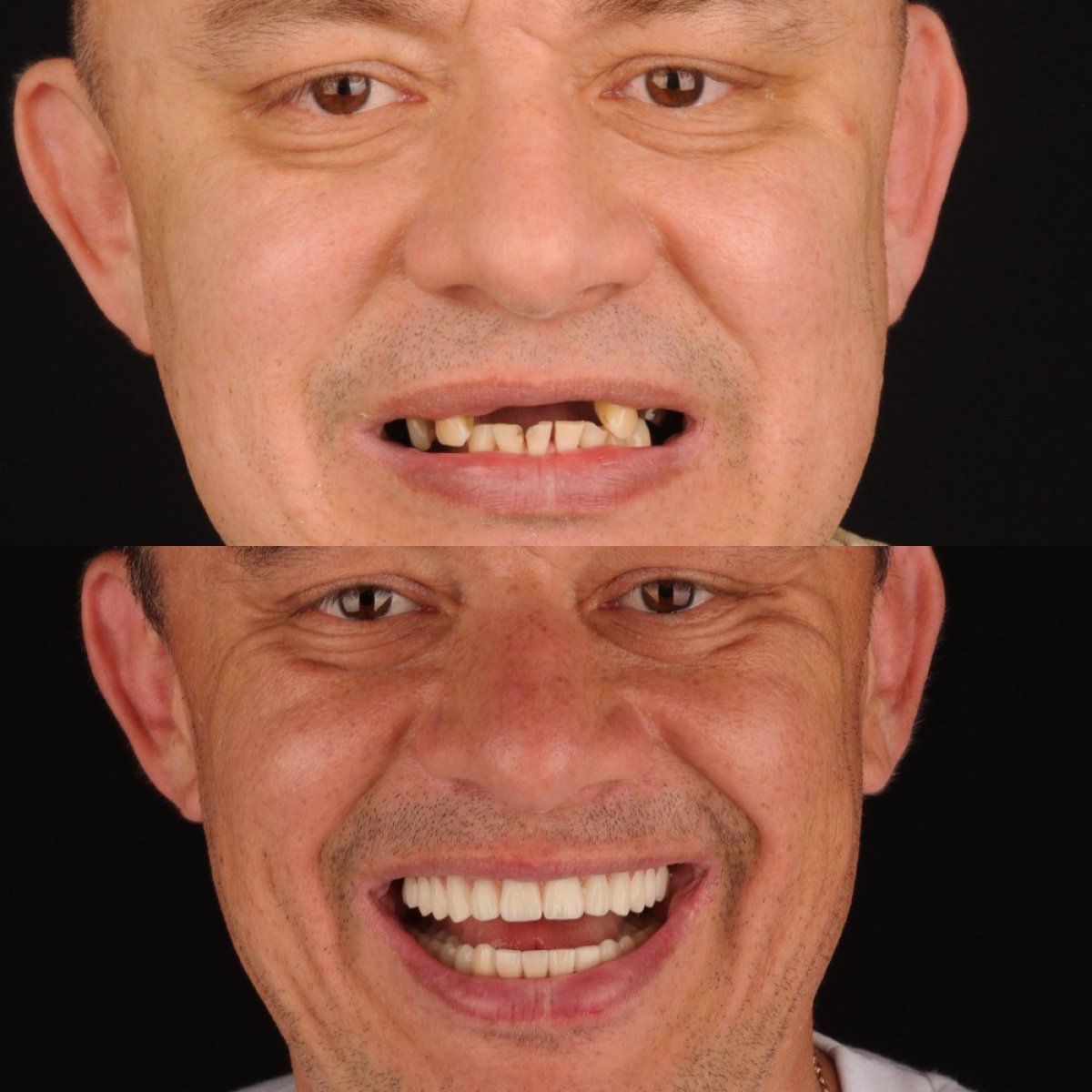 نتائج قبل وبعد زراعة الأسنان في The Dental Concept by RIKOTA، ابتسامة مستعادة