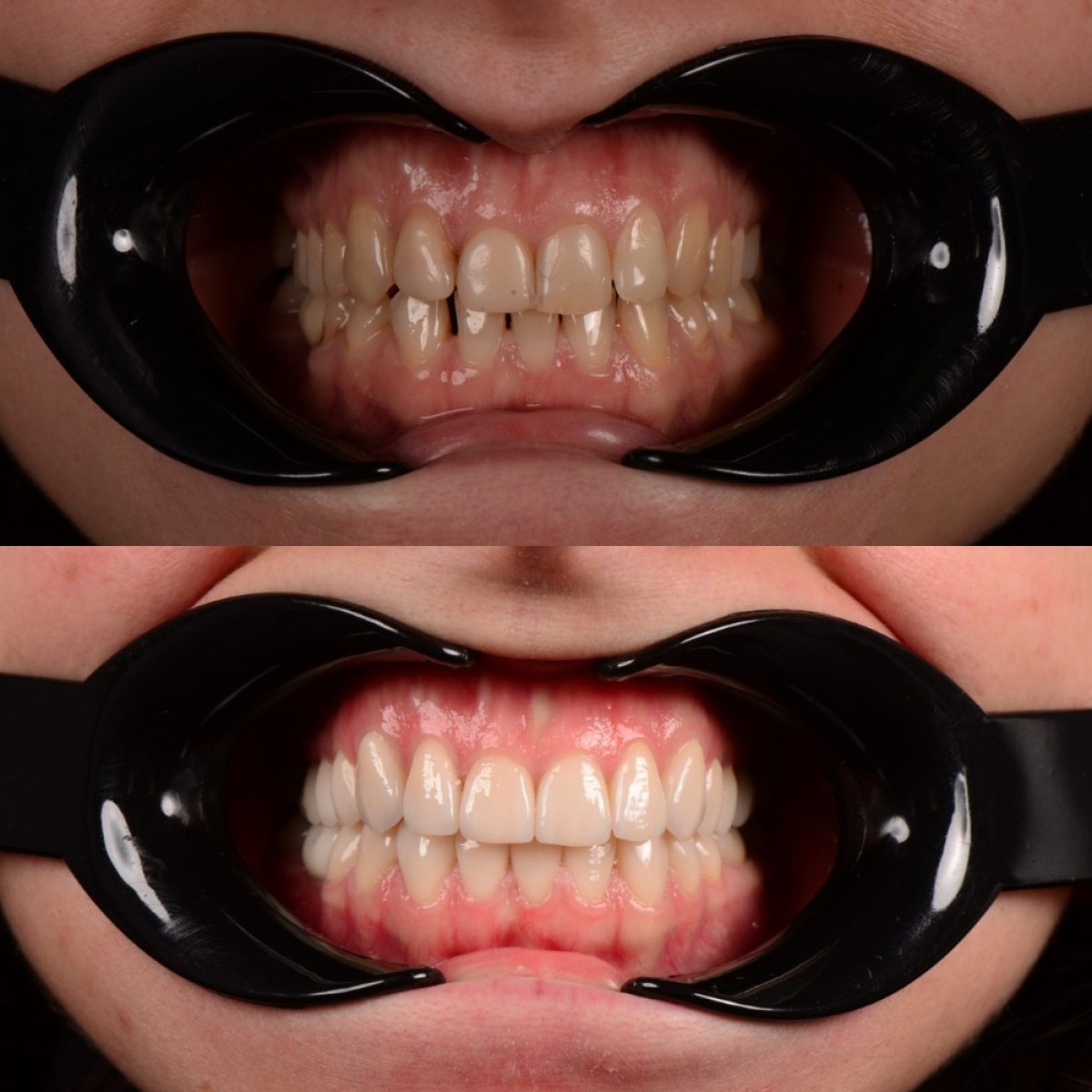 نتائج قبل وبعد التقويم في The Dental Concept by RIKOTA – أسنان مستقيمة ومتناسقة