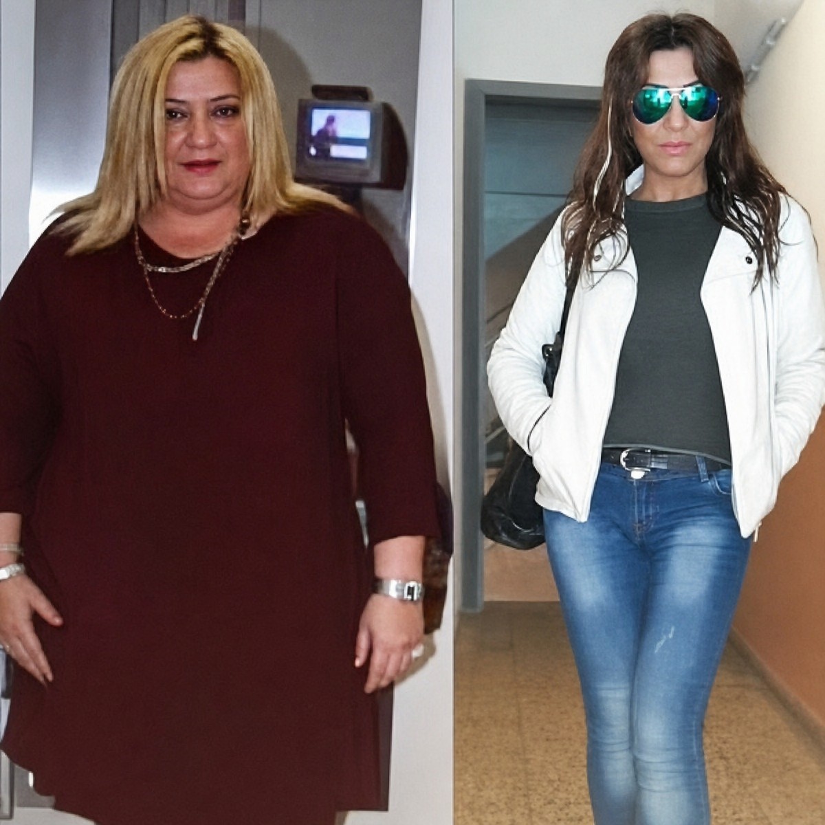 قبل وبعد عملية تكميم المعدة في Memorial Göztepe Hospital، نتيجة فقدان وزن ملحوظة