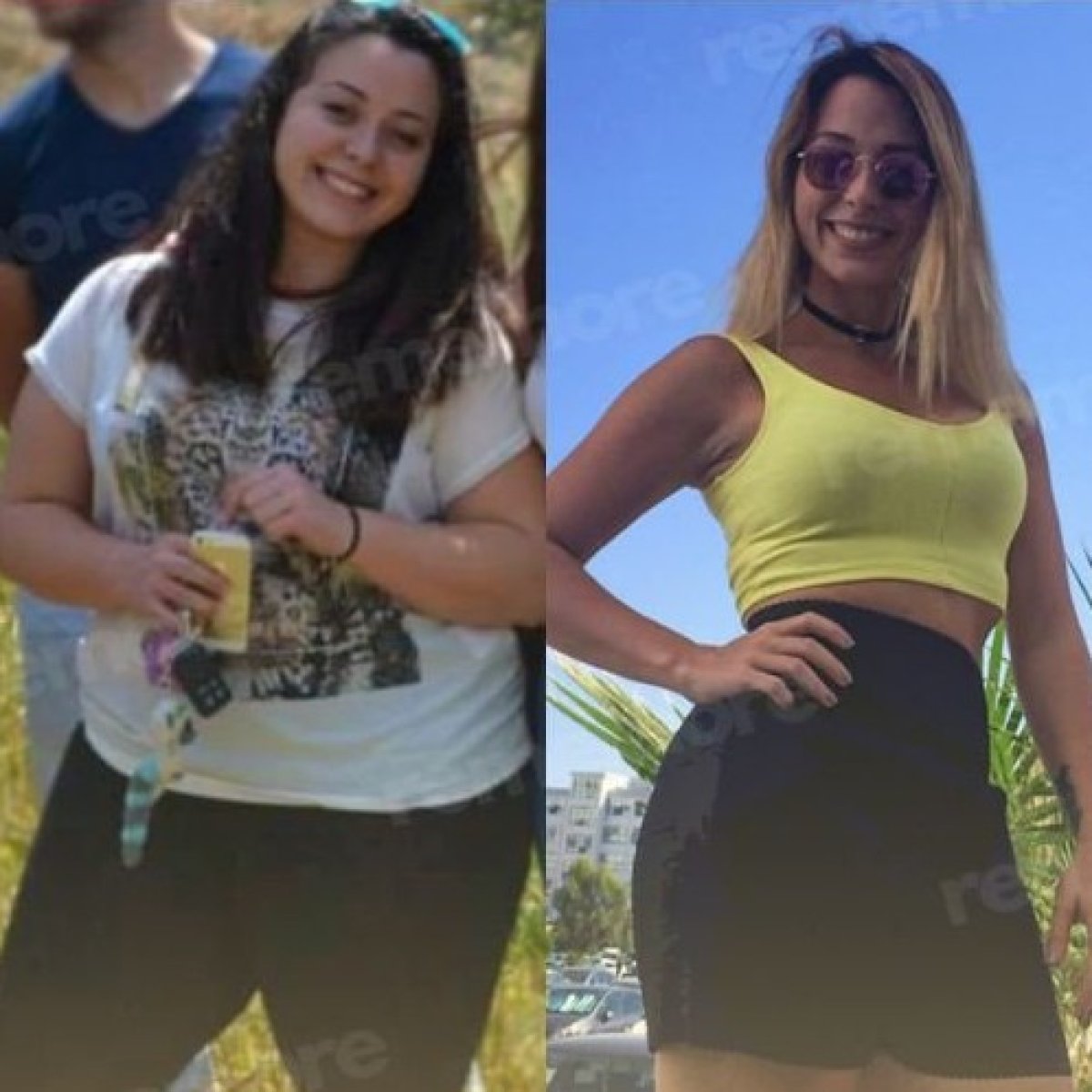 Before and after gastric sleeve surgery results at Memorial Göztepe Hospital, visible weight loss