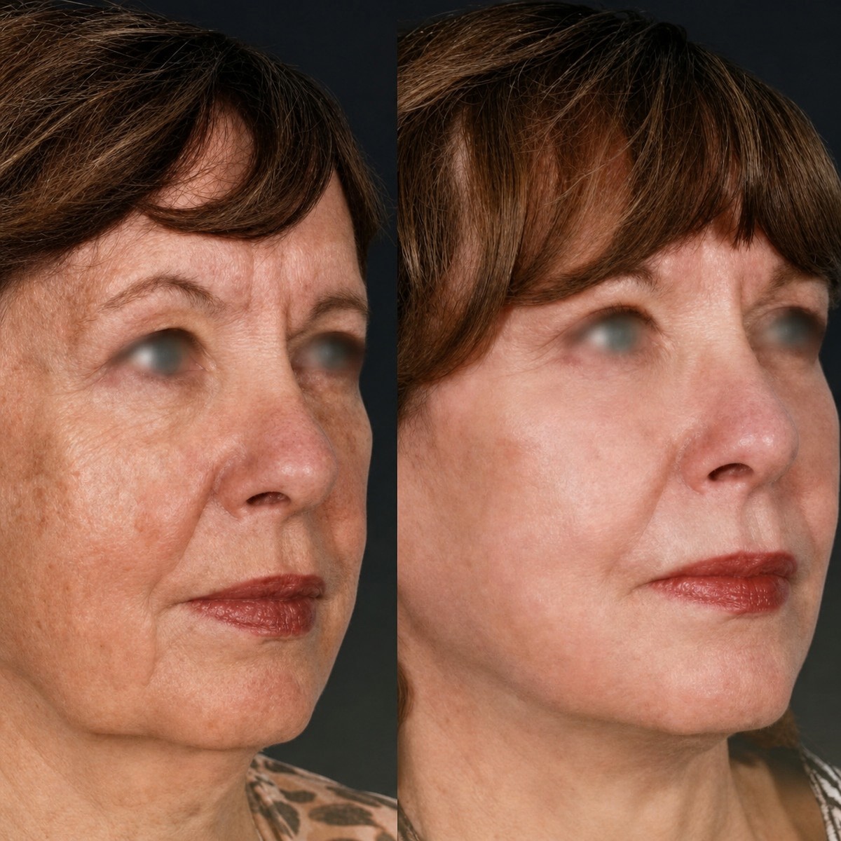 Facelift before and after results at Memorial Göztepe Hospital, visible facial rejuvenation