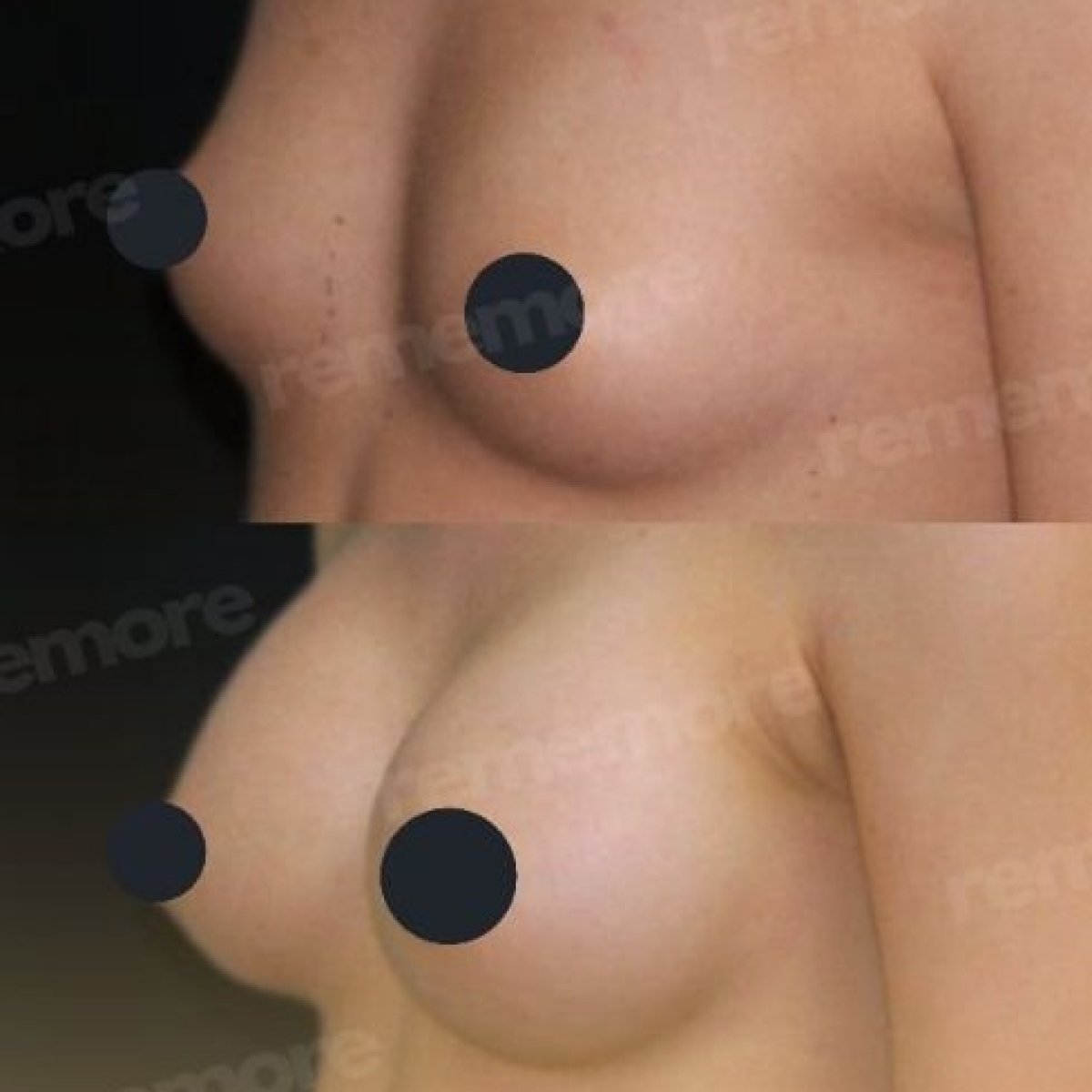 Before and after breast augmentation at Memorial Göztepe Hospital, enhanced breast volume result
