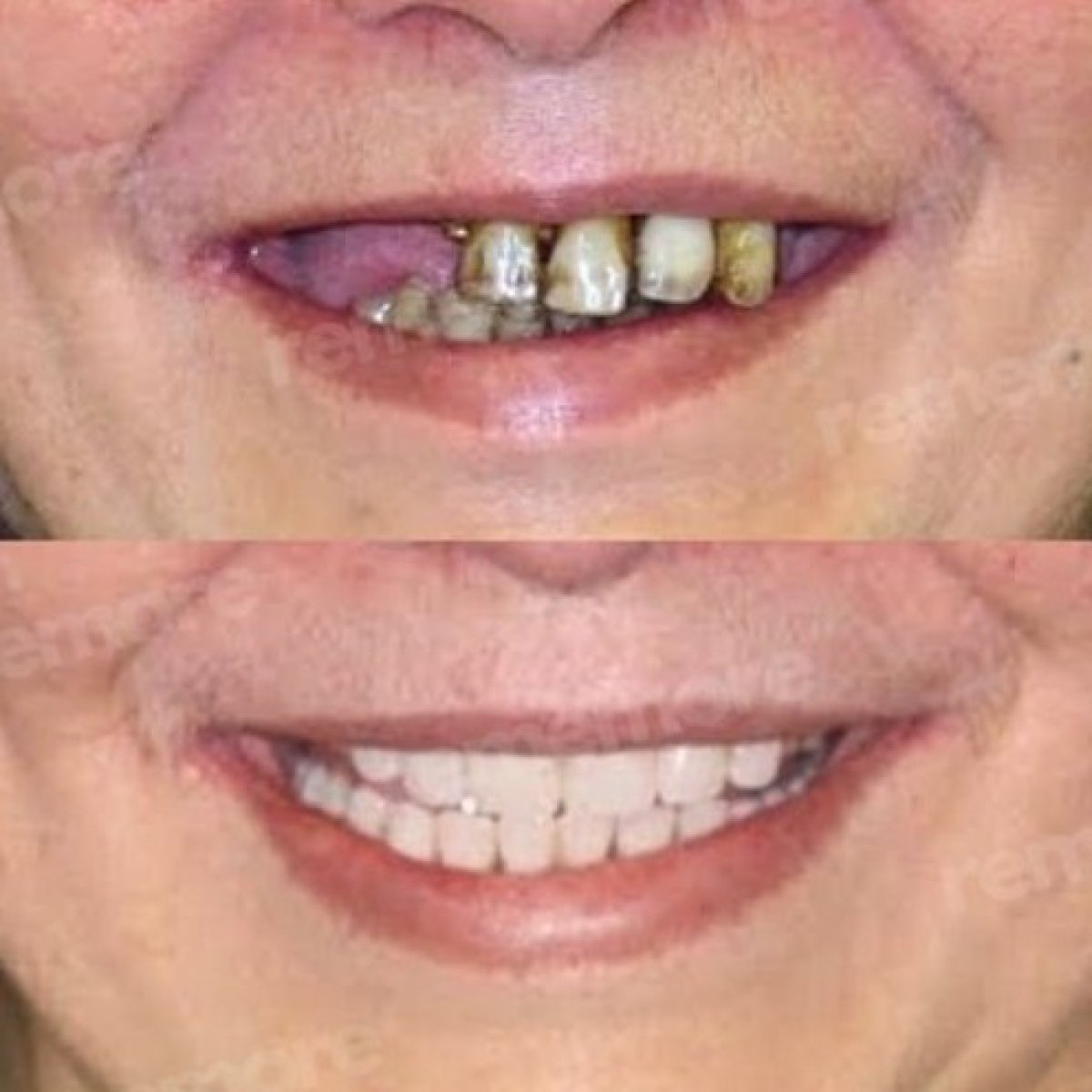 Resultado antes y después de carillas sin tallado en Memorial Bahçelievler Hospital, transformación de sonrisa