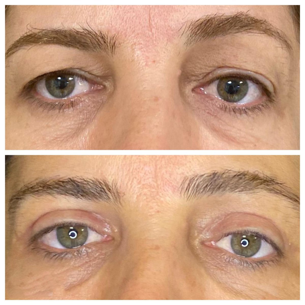 Before and after blepharoplasty results at Dunyagoz Eye Hospital Antalya, eyelid correction