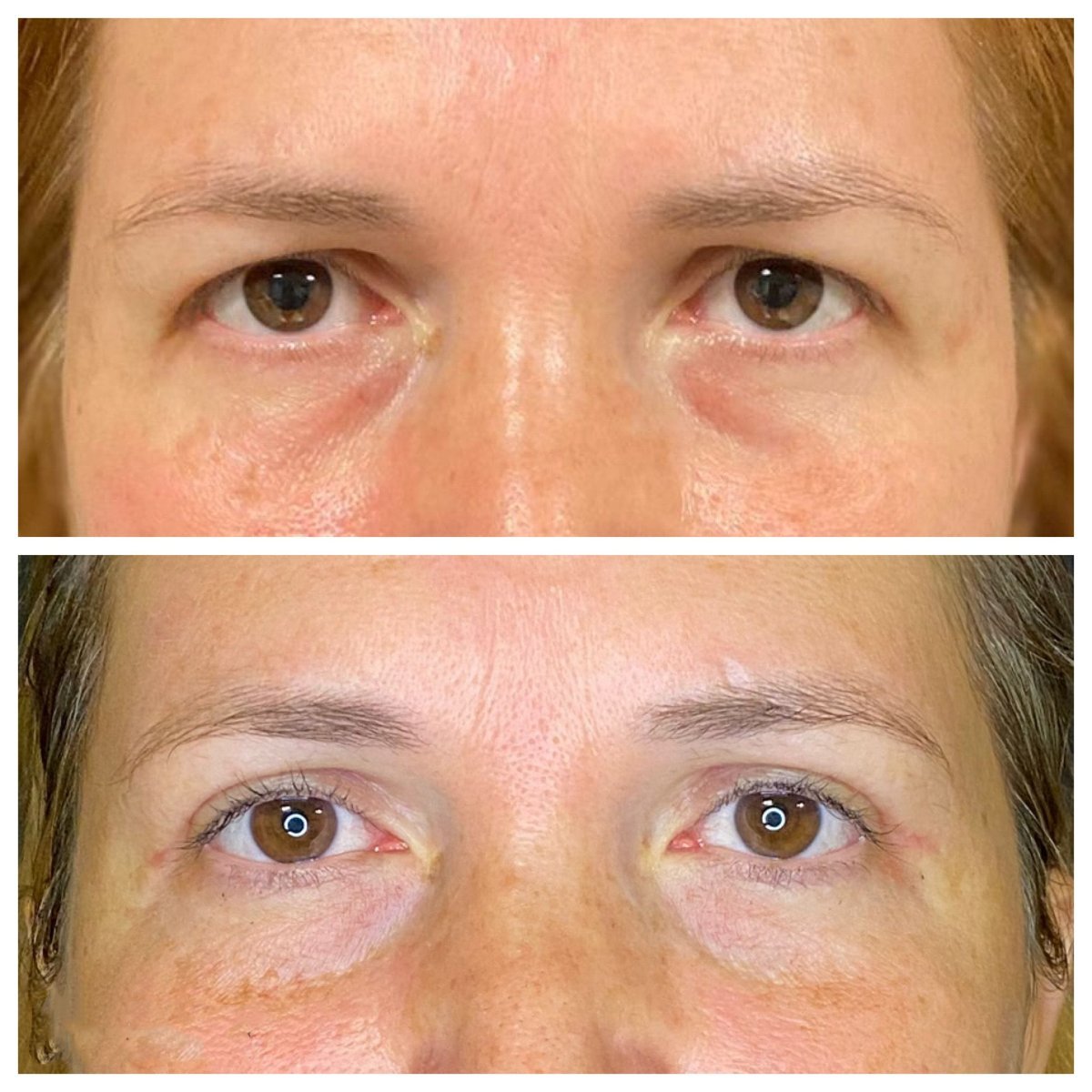 Before and after blepharoplasty results at Dunyagoz Eye Hospital Antalya, eyelid correction