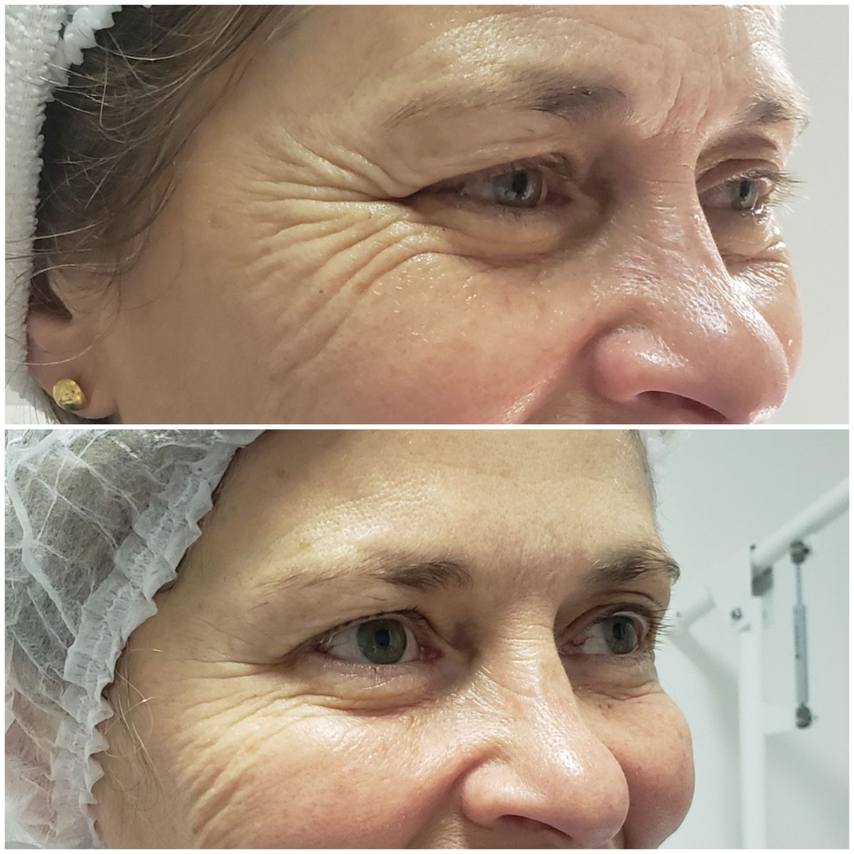 Antes y después de inyecciones de botox en Clinica Granado Tiagonce, menos arrugas en ojos