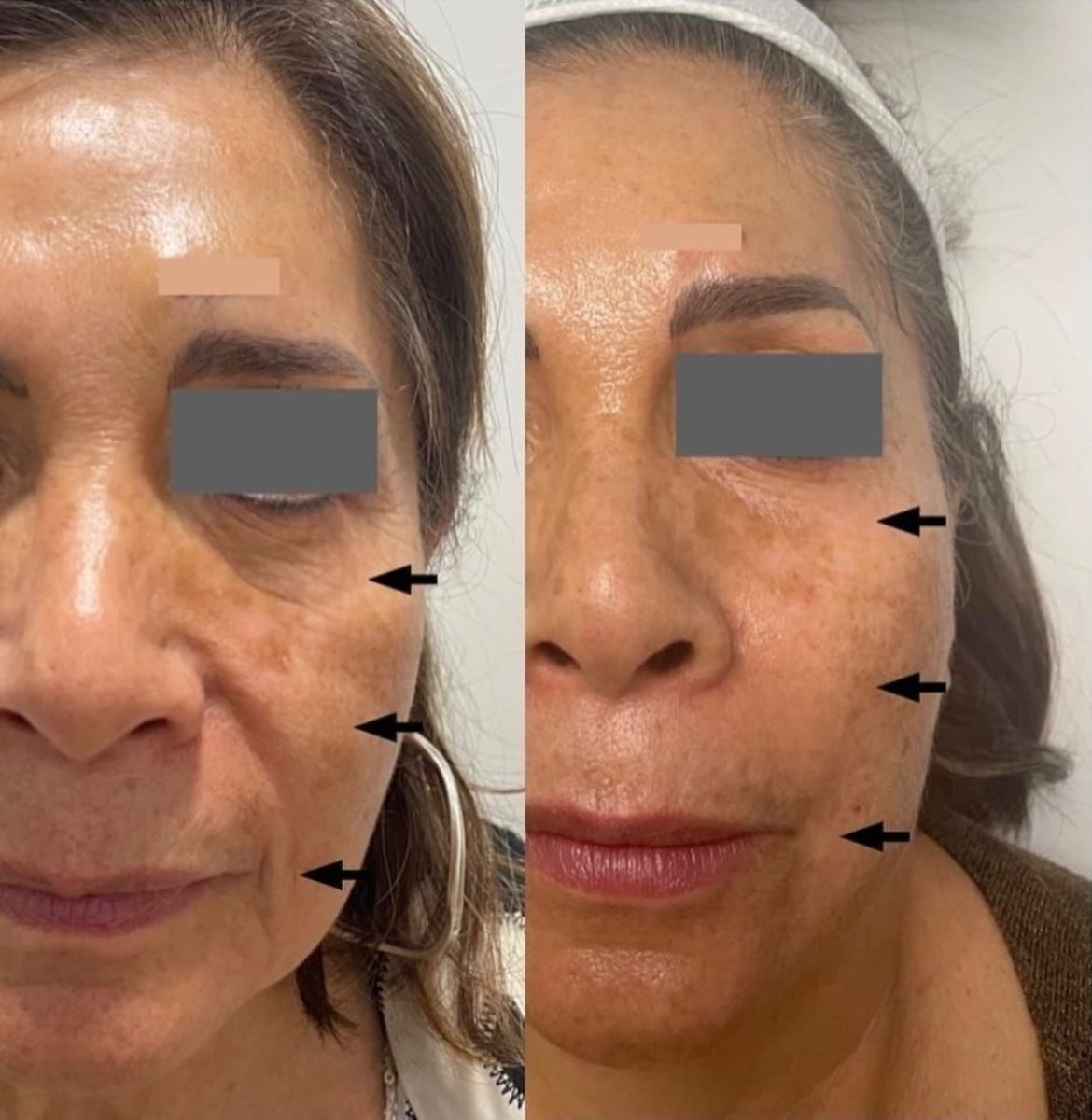 قبل وبعد حقن الفيلر في عيادة Dr. Lavalle، نتيجة تجديد شباب الوجه