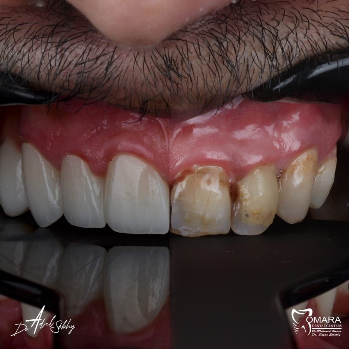 Before and after zirconia crown installation at Omara Dental Centers, visible smile restoration result