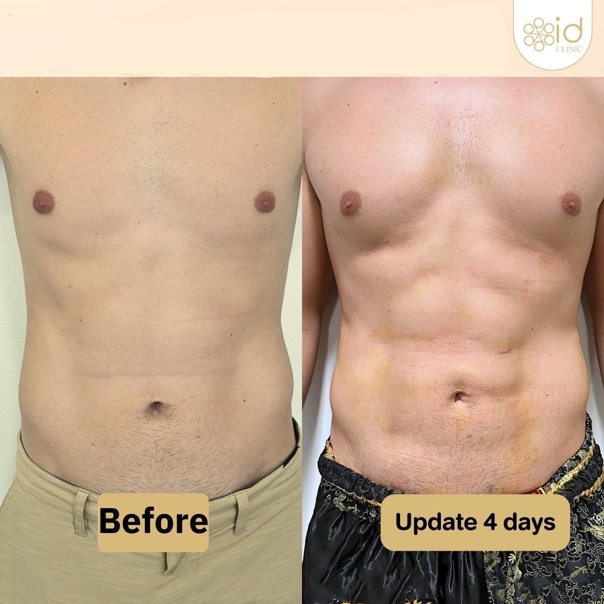 Before and after Vaser liposuction results at ID Clinic Bangkok, visible abdominal contouring